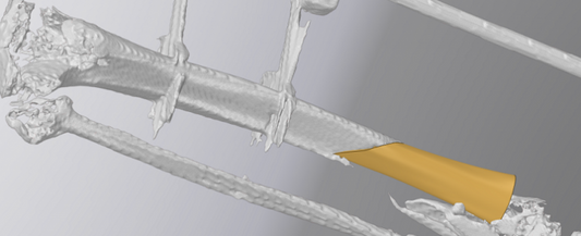 First Tibial Implant